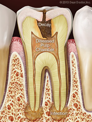 شکل- تصویر سمت راست ساختار داخل دندان (متشکل از مینا، عاج و پالپ که حاوی رگهای خونی و عصب است) در حالت سالم و تصویر سمت چپ همان دندان در شرایط پوسیدگی و عفونت پالپ و نوک ریشه را نشان میدهد.