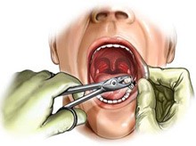باورهای نادرست درباره عصب ‌کشی دندان