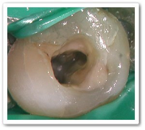 ترمیم و بازسازی دندان پس از درمان ریشه یا عصب‌ کشی