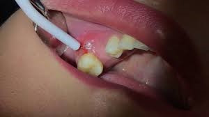 ابسه دندان