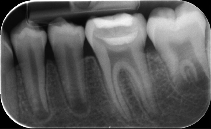 روش‌های معاینه پالپ دندان