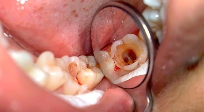 پالپیت یا التهاب داخل دندان