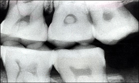 پولیپ دندان