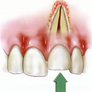 انواع جراحات پالپ دندان و درمان آنها