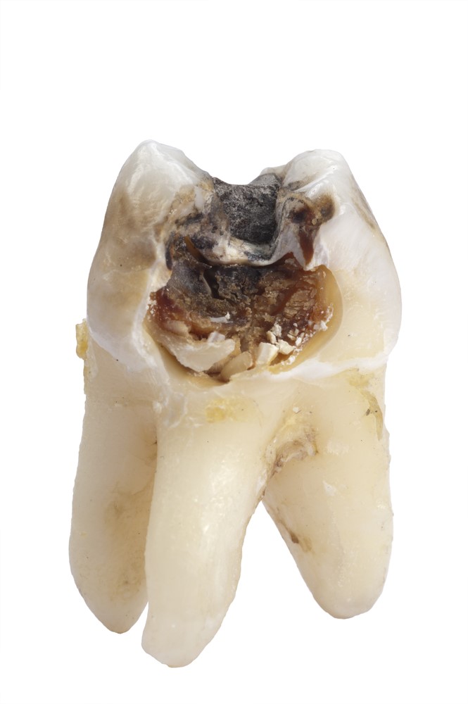 چه عواملی باعث عفونت دندان میشوند؟