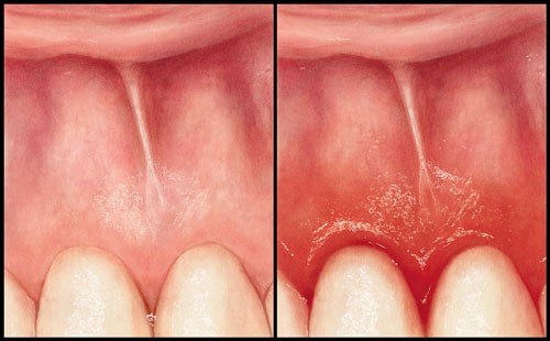 چه عواملی باعث عفونت دندان میشوند؟