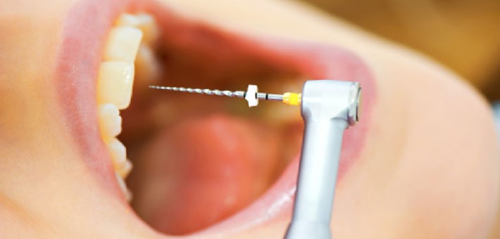 علائم هشدار دهنده نیاز به درمان ریشه دندان