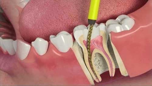سؤالات پرتکرار در مورد درمان ریشه یا عصب کشی دندان