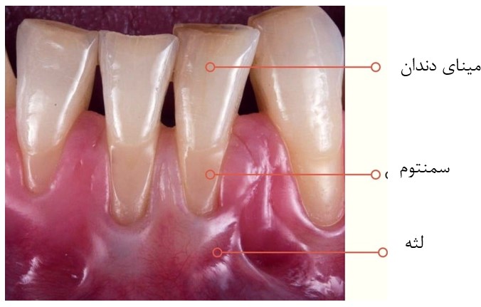 سمنتوم دندان چیست؟