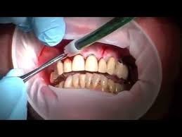 آبسه‌ی دندان و تحلیل رفتن استخوان زیر لثه