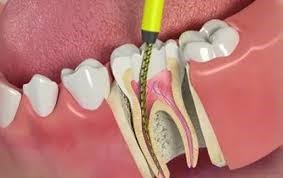 مواد پر کننده‌ کانال دندان