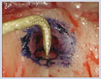 درمان ریشه با میکروسکوپ دندانپزشکی