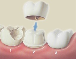 تفاوت روکش دندان و پر کردن دندان