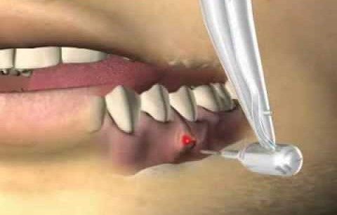 کیست های دندانی