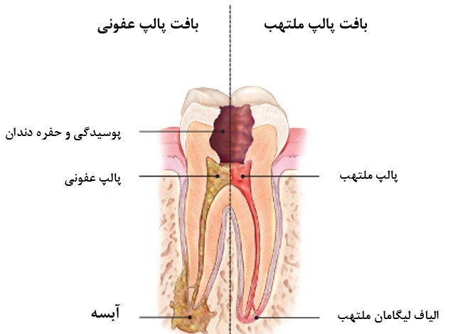 آبسه دندان پس از عصب کشی