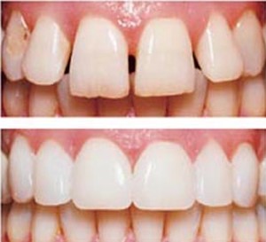 مقایسه انواع روکش دندان