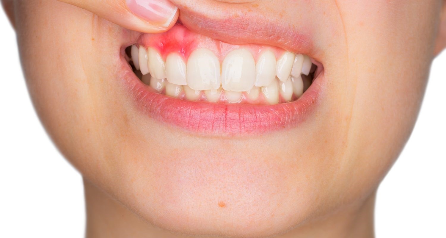 آبسه دندان پس از عصب کشی