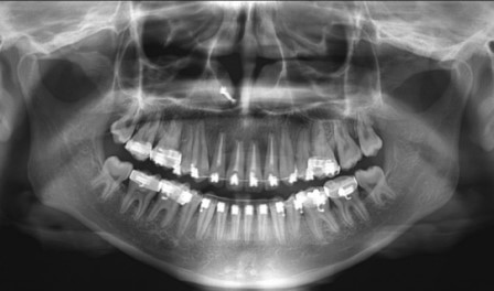 عصب کشی و ارتودنسی دندان