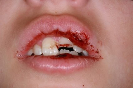 آسیب و ضربه دیدن دندان
