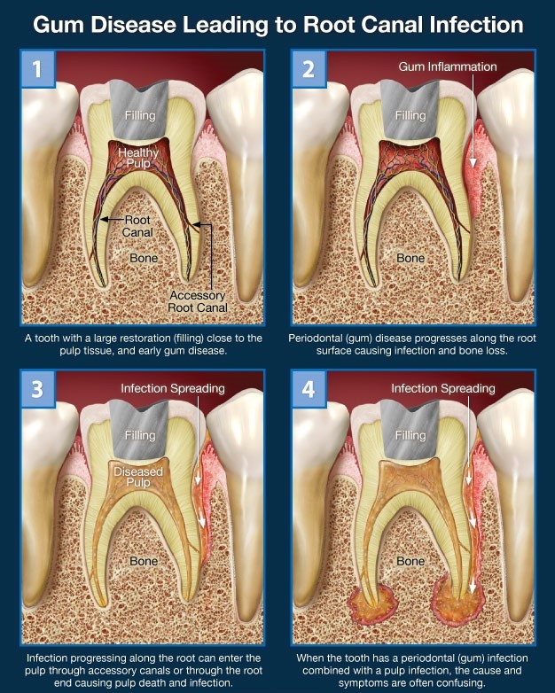 درد دندان و عفونت لثه