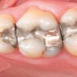 پاسخ پرسش های شما در مورد آمالگام های دندانی