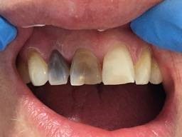 تشخیص و درمان دندان از دست رفته