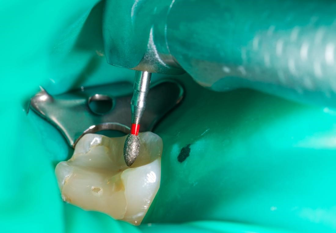 آیا درمان ریشه دندان باعث سرطان میشود؟