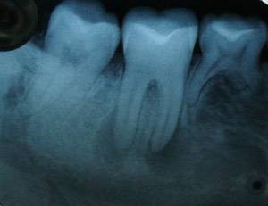 تشخیص و درمان دندان از دست رفته