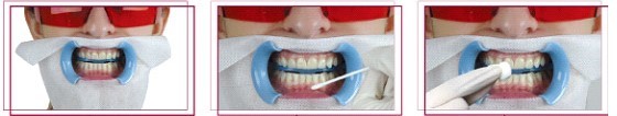 آفیس بلیچینگ یا سفید کردن تخصصی دندان در مطب