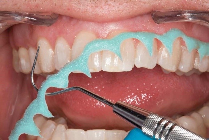 отбеливание зубов opalescence это