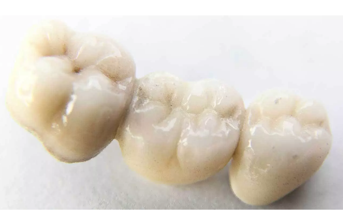 بریج های دندانی جایگزینی برای دندان های از دست رفته