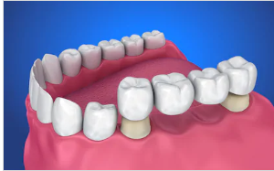 بریج های دندانی جایگزینی برای دندان های از دست رفته