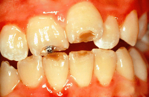 هیپوپلازی مینای دندان یا درمان دندان گچی