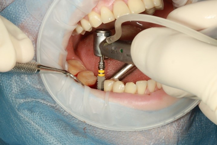 عفونت ایمپلنت دندانی
