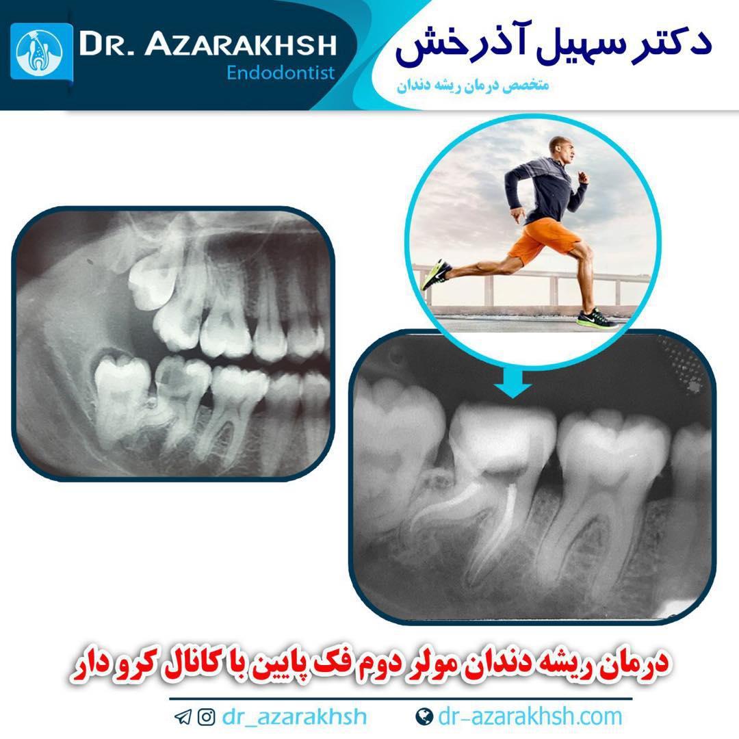 درمان ریشه دندانی از نوع دونده 
