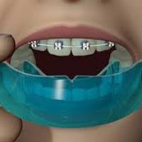 محافظ دندان در طول درمان ارتودنسی