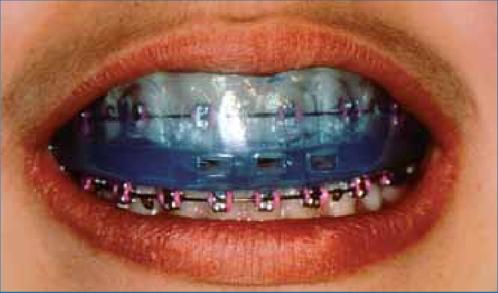 محافظ دندان در طول درمان ارتودنسی