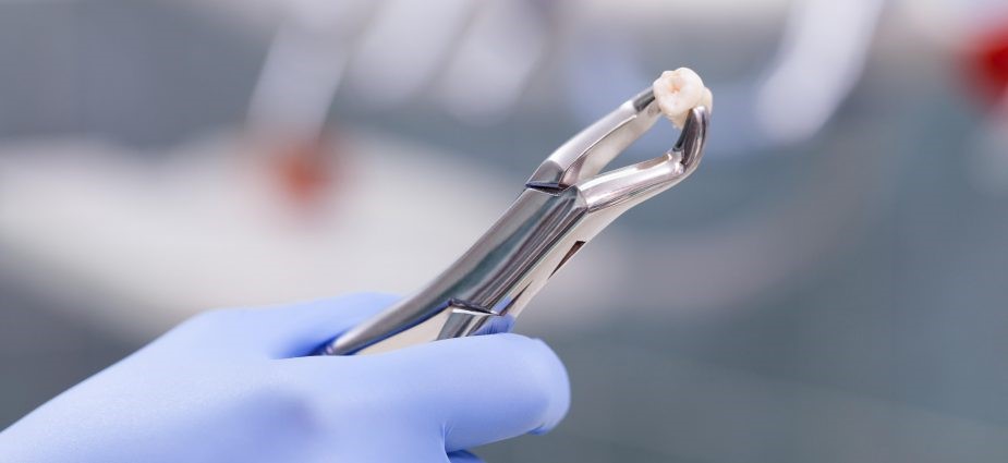 کشیدن دندان در طول درمان ارتودنسی