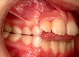 تانگ تراست یا فشردن زبان پشت دندان