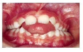 تانگ تراست یا فشردن زبان پشت دندان