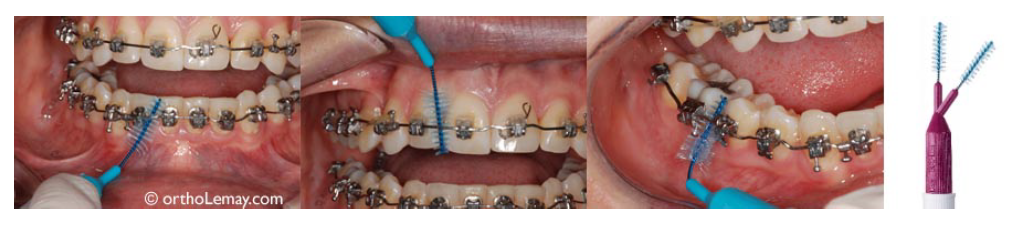 بهداشت دهان در طول درمان ارتودنسی