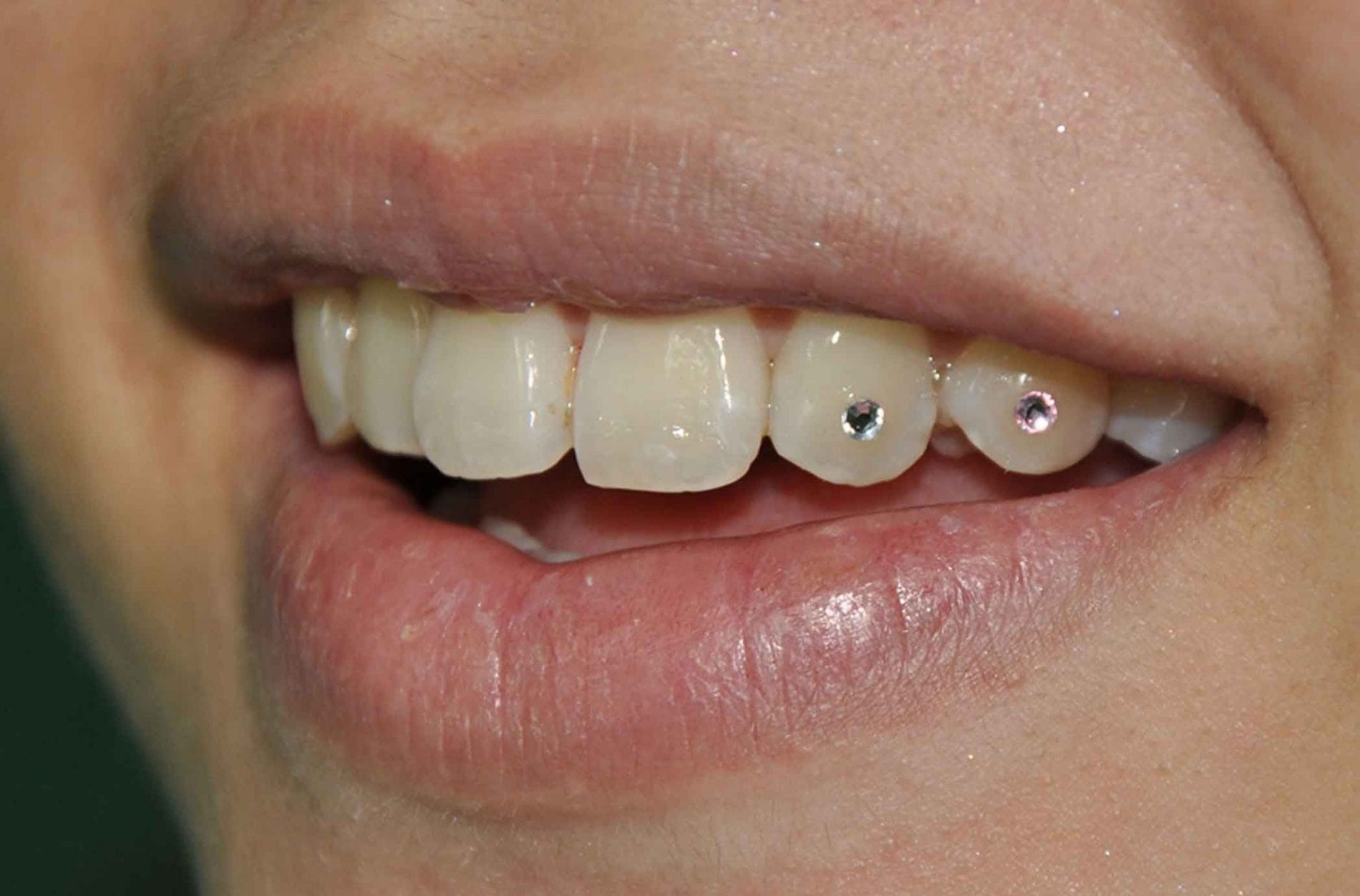 خطرات پیرسینگ دندان