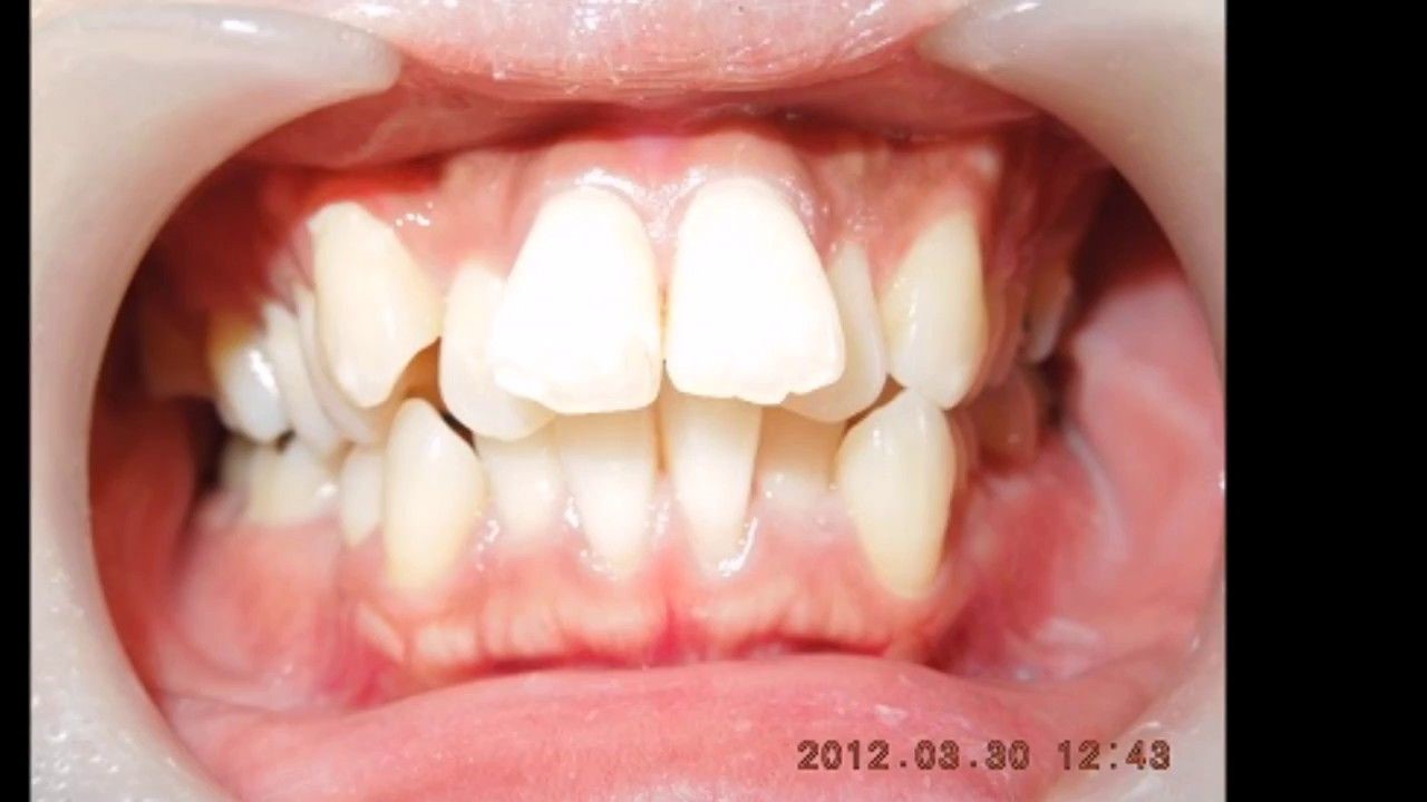 فشردگی یا نامرتبی دندان ها