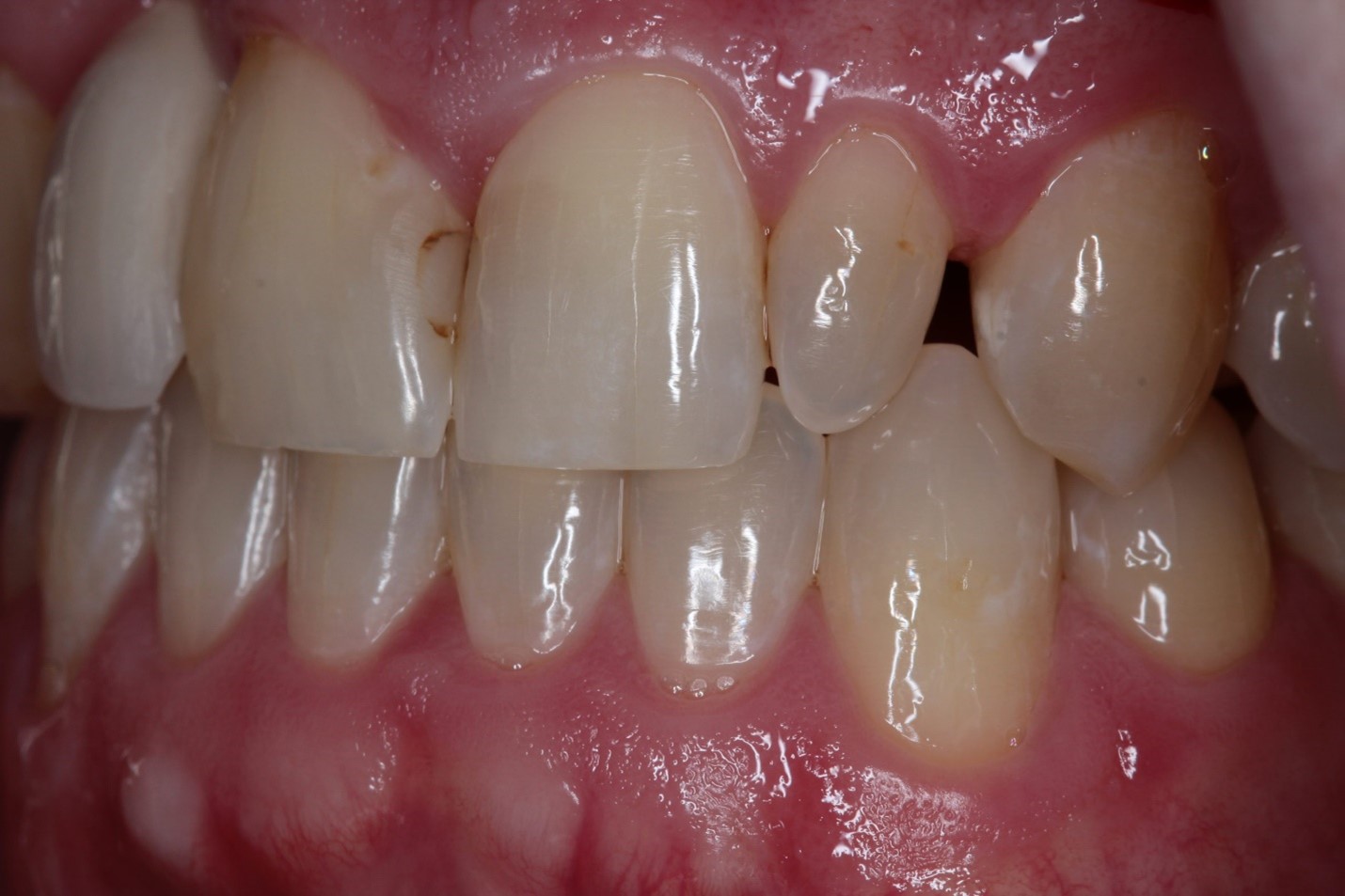 اصلاح کوچک بودن دندان یا میکرودنشیا
