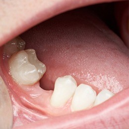 ارتودنسی  دندان ایمپلنت شده