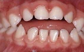 تاثیر مکیدن پستانک روی دندان کودکان