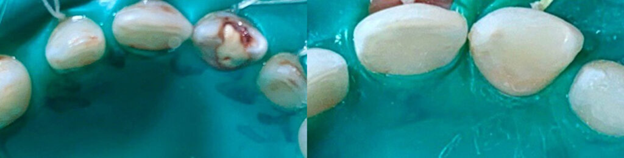 درمان پالپیت در دندان شیری کودکان