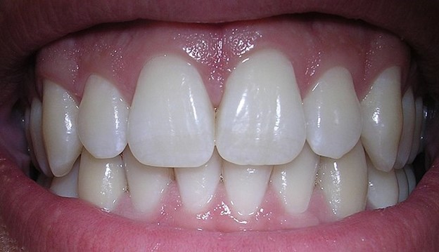 شکل صحیح قرار گرفتن دندانها روی هم