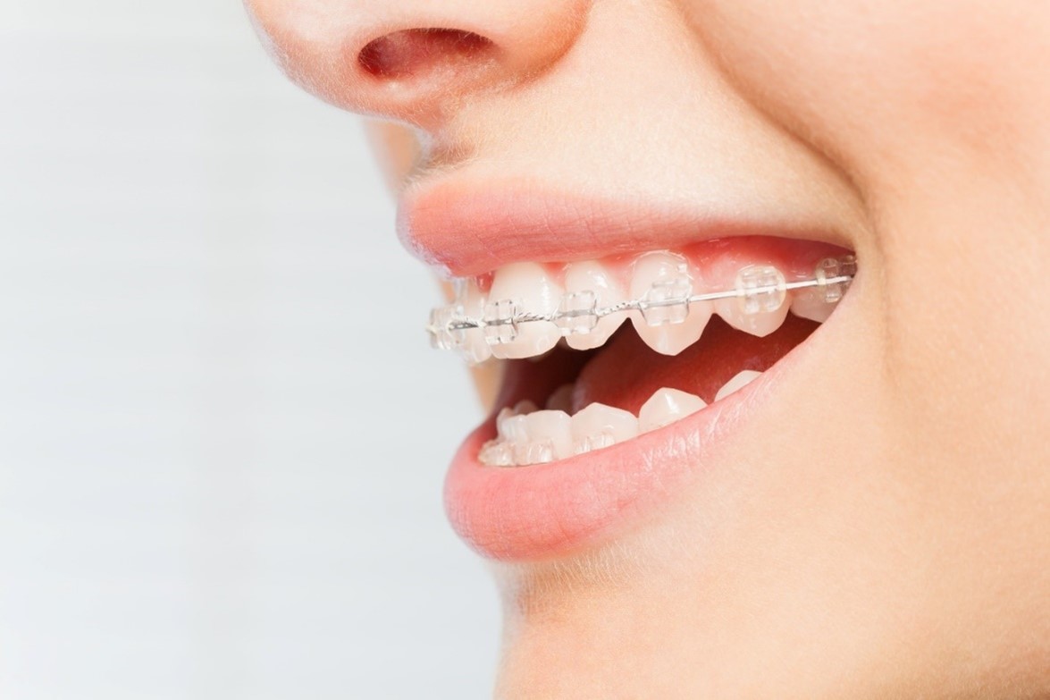 خطرات باقی ماندن طولانی مدت براکت روی دندان