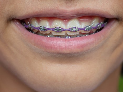 خطرات باقی ماندن طولانی مدت براکت روی دندان
